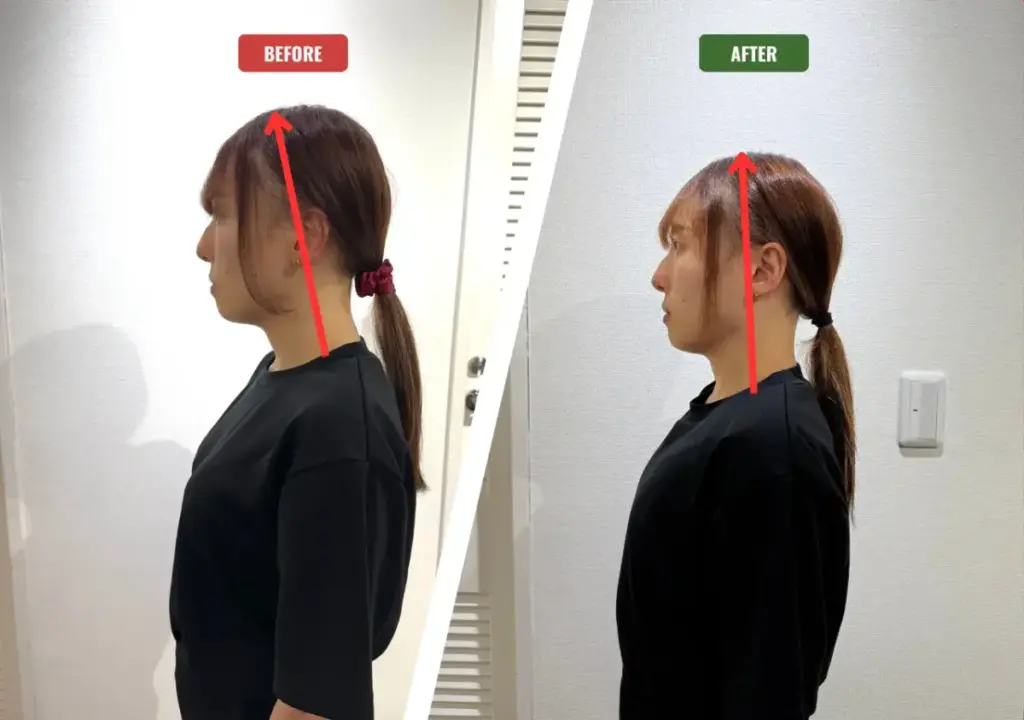 駅前筋肉留学GOで実際に3ヶ月姿勢改善に挑戦した際のビフォーアフター画像(ストレートネック改善)